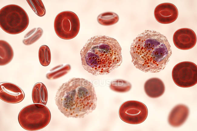 Frotis de sangre eosinofilia con numerosos eosinófilos, ilustración digital
. - foto de stock