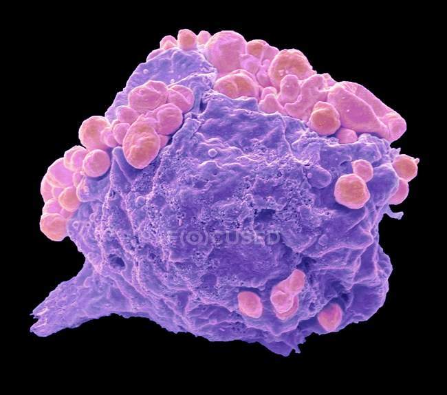 Colored scanning electron micrograph of lymphoma cell showing early apoptotic change. — Stock Photo