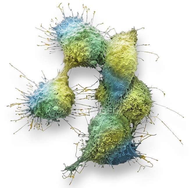 Кольорові мікрофотографія клітин раку яєчників. — стокове фото