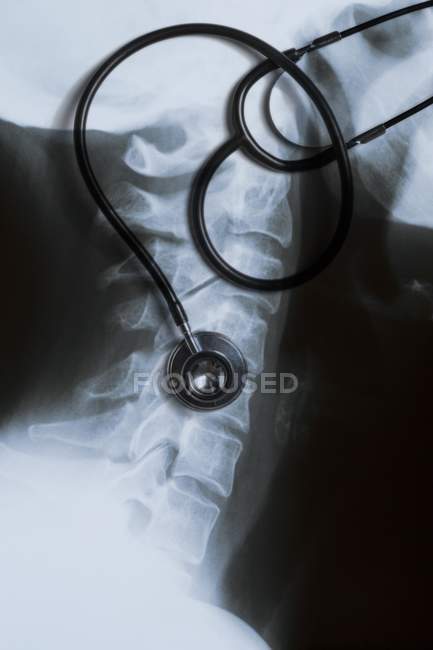 Radiografía del cuello con estetoscopio, primer plano . - foto de stock