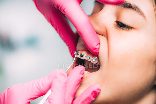 Manos de ortodoncista revisando frenos dentales de niña en la clínica . - foto de stock