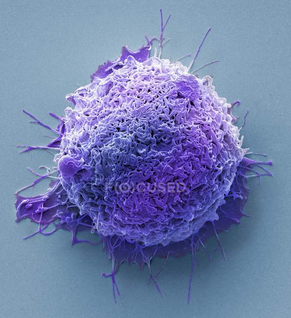 Кольорові мікрофотографія ракових клітин з людського товстої кишки. — стокове фото