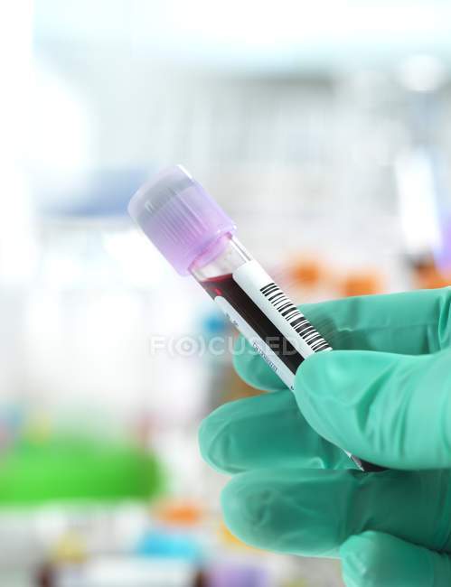 Técnico de mano sosteniendo la muestra de sangre lista para su análisis en laboratorio
. - foto de stock