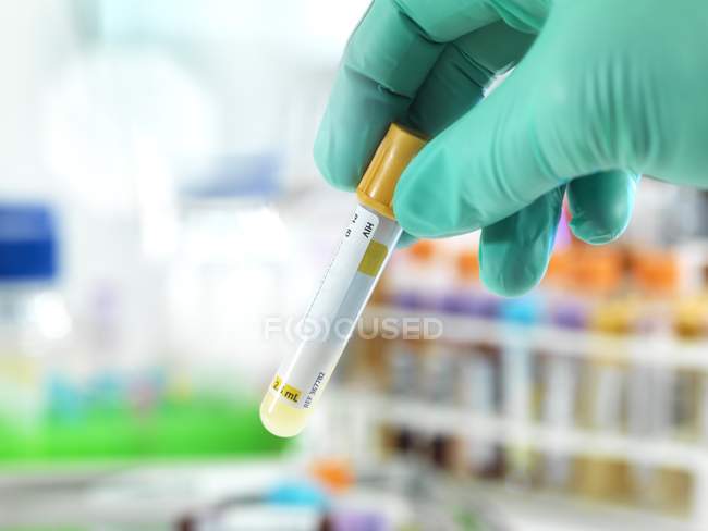 Médico preparando la muestra de prueba del VIH para pruebas en laboratorio
. - foto de stock
