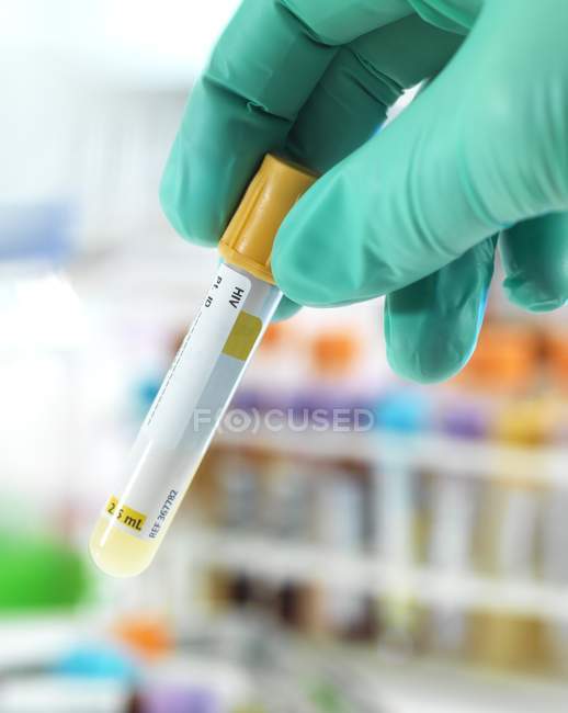 Arzt bereitet Hiv-Probe für Tests im Labor vor. — Stockfoto