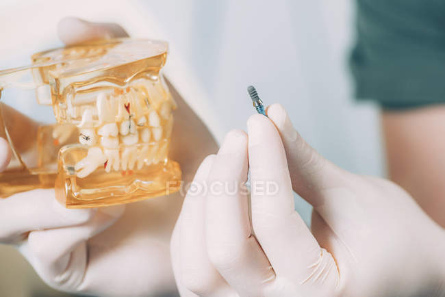 Dentista sosteniendo implante dental y mandíbula modelo en las manos . - foto de stock
