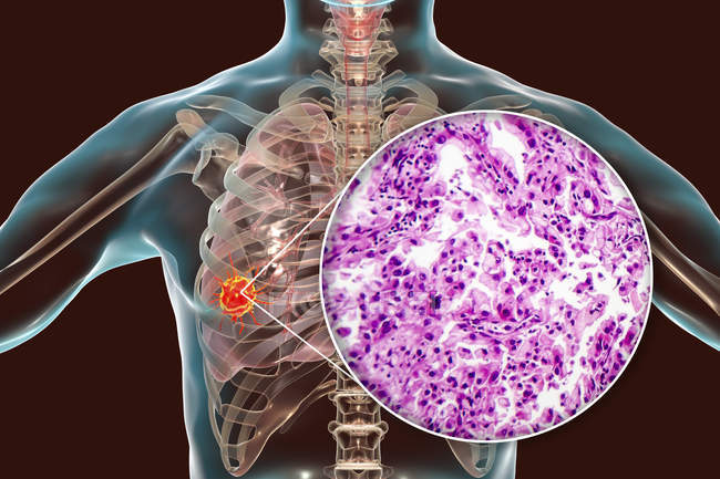 Cáncer de pulmón, ilustración digital y micrografía ligera de tejido canceroso . - foto de stock