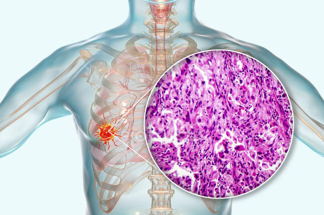Cancer du poumon, illustration numérique et micrographie lumineuse du tissu cancéreux
. — Photo de stock