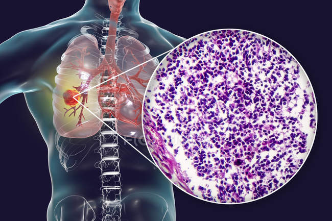 Рак легких, цифровая иллюстрация, показывающая злокачественную опухоль легких . — стоковое фото