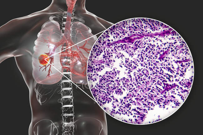 Рак легенів, цифрова ілюстрація, що показує злоякісну пухлина в легенях. — стокове фото