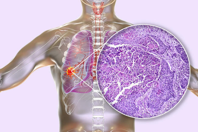 Illustrazione digitale e micrografo leggero del carcinoma a cellule squamose del polmone . — Foto stock