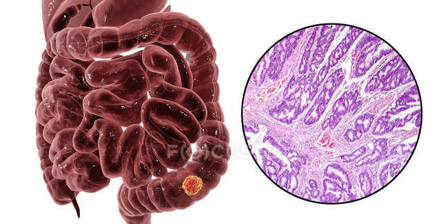 Colon cancer, digital illustration and light micrograph showing colon adenocarcinoma. — Stock Photo