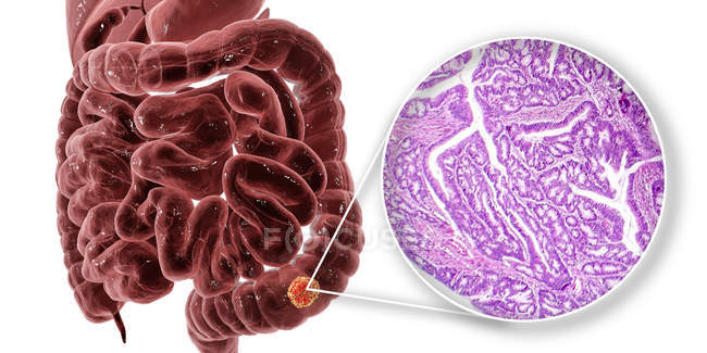Cancro al colon, illustrazione digitale e micrografo luminoso che mostra adenocarcinoma del colon . — Foto stock
