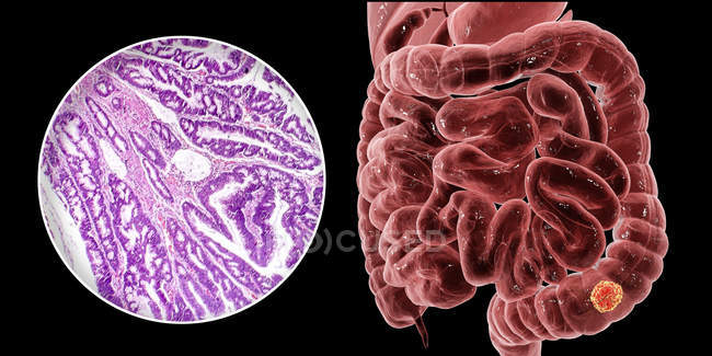 Cáncer de colon, ilustración digital y micrografía de luz que muestra adenocarcinoma de colon
. - foto de stock
