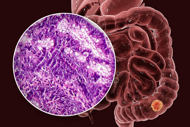 Cancro al colon, illustrazione digitale e micrografo luminoso che mostra adenocarcinoma del colon . — Foto stock