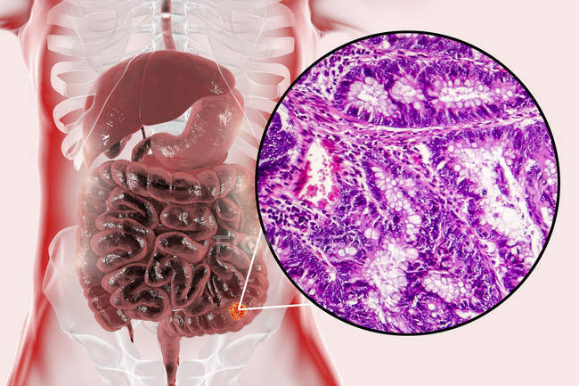 Рак товстої кишки, цифрова ілюстрація і світло мікрограф показує колон аденокарцинома. — стокове фото