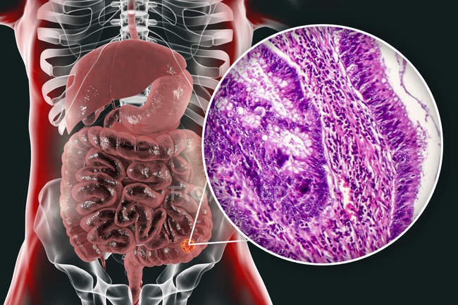 Рак толстой кишки, цифровая иллюстрация и световая микрография, показывающая аденокарциному толстой кишки
. — стоковое фото