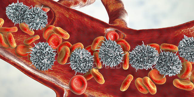 Digital illustration of abnormal white blood cells B-lymphocytes while hairy cell leukaemia. — Stock Photo