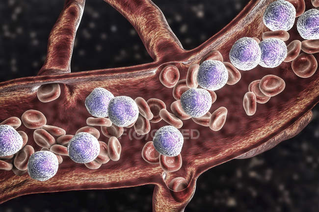 Digital illustration of cross-section of blood vessel with acute lymphoblastic leukaemia showing abundant lymphoblasts. — Stock Photo