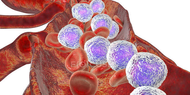 Цифровая иллюстрация поперечного сечения кровеносных сосудов с острым лимфобластным лейкозом, показывающая обильные лимфобласты
. — стоковое фото