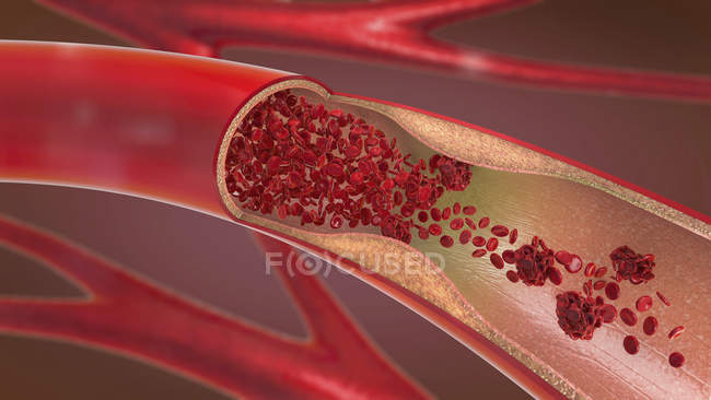 3d ilustración de arteria estrechada y estrechada, mientras que la arteriosclerosis
. - foto de stock
