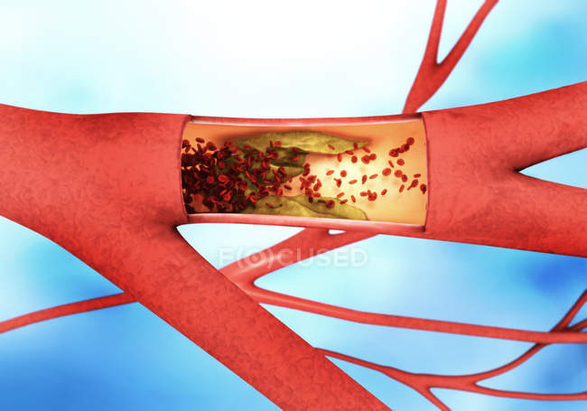 3D digitale Illustration verengter Blutgefäße. — Stockfoto