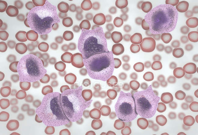 3d ілюстрація, що показує збільшення нефункціональних білих кров'яних клітин у лейкемії . — стокове фото