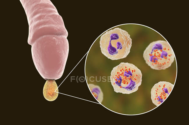 Gonorrhoea infection causing by bacteria Neisseria gonorrhoeae in male organ while urethritis, digital illustration. — Stock Photo