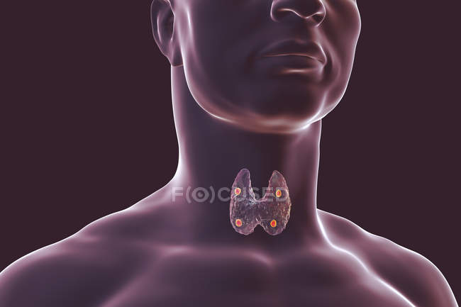 Ilustração digital de glândulas paratireoides vermelhas acentuadas situadas atrás da glândula tireoide em silhueta humana . — Fotografia de Stock