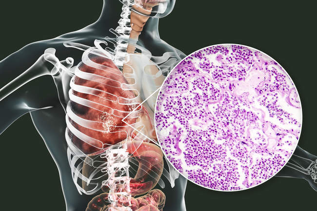 Lungenentzündung im Stadium der grauen Hepatitis oder späten Konsolidierung, digitale Illustration und Lichtmikroskopie. — Stockfoto