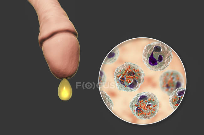 Infección por gonorrea causada por bacterias Neisseria gonorrhoeae en órganos masculinos mientras que uretritis, ilustración digital
. - foto de stock