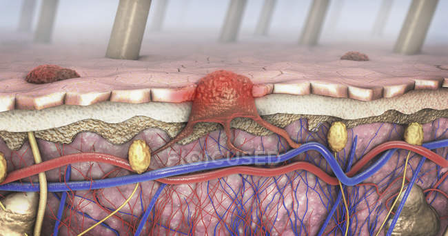 3D-Illustration eines Hautschnitts mit Melanom im Blutkreislauf und Lymphtrakt. — Stockfoto