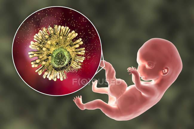 Предотвращение передачи ВИЧ от инфицированной матери к эмбриону человека, концептуальная иллюстрация
. — стоковое фото