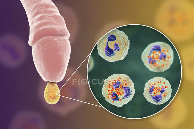 Infezione da gonorrea causata da batteri Neisseria gonorrhoeae nell'organo maschile mentre uretrite, illustrazione digitale . — Foto stock