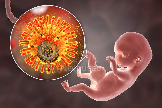Prevención de la transmisión transplacentaria del VIH al embrión humano de madre infectada, ilustración conceptual
. - foto de stock