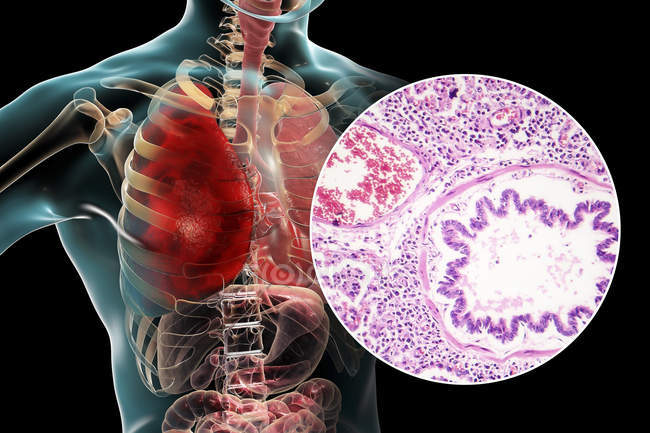 Lungenentzündung im Stadium der roten Hepatisation, digitale Illustration und Lichtmikroskopie. — Stockfoto