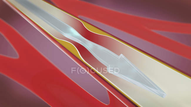 Illustrazione 3d dell'arteria ristretta e ristretta durante l'arteriosclerosi . — Foto stock