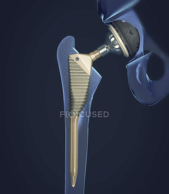 Імплантат заміни кульшового суглоба, медична цифрова ілюстрація . — стокове фото