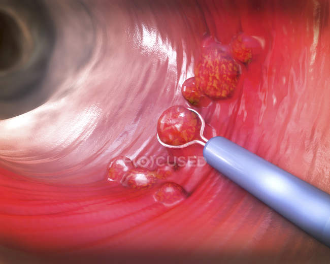 Ilustração da remoção do pólipo colônico com alça de arame elétrico durante a colonoscopia
. — Fotografia de Stock