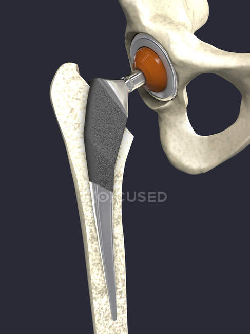 Implante de reemplazo de cadera, ilustración digital médica . - foto de stock