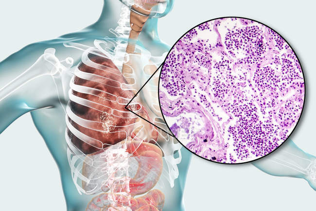 Lobar pneumonia in stage of grey hepatisation or late consolidation, digital illustration and light micrograph. — Stock Photo