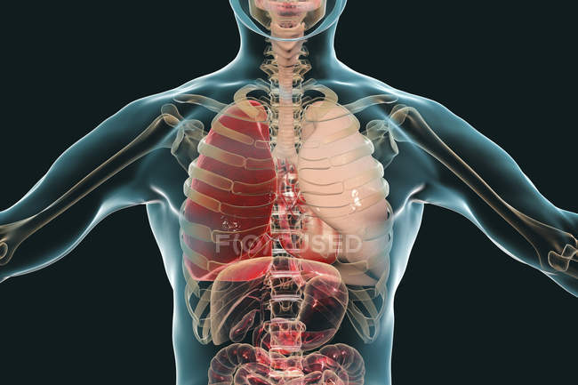 Лобарная пневмония в стадии красной гепатизации, концептуальная цифровая иллюстрация
. — стоковое фото