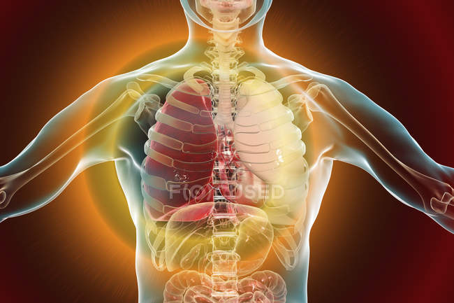 Lungenentzündung im Stadium der roten Hepatitis, konzeptionelle digitale Illustration. — Stockfoto
