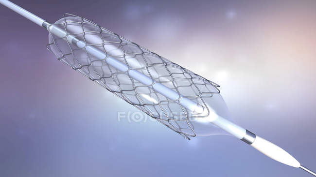 Стента та повітряна куля для імплантації в кровоносні судини, цифрова ілюстрація. — стокове фото