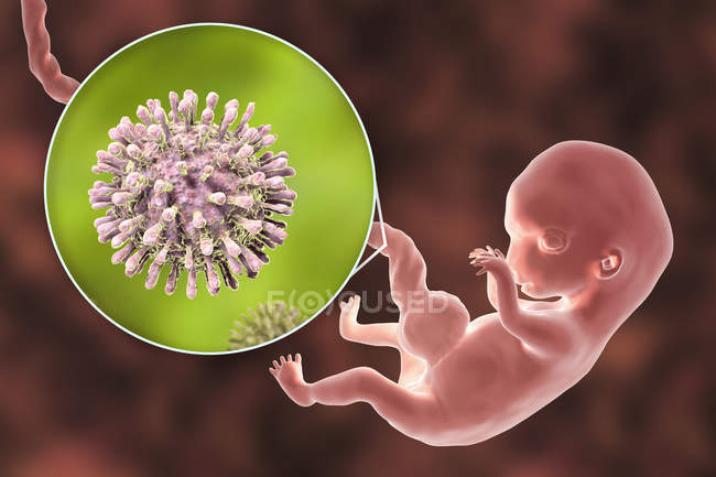 Transmisión transplacentaria del VIH infectando embriones humanos de 8 semanas, ilustración conceptual . - foto de stock