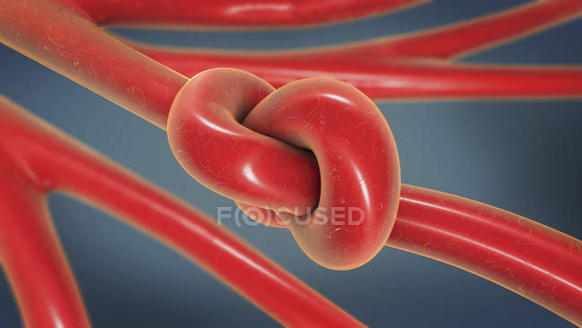 3d illustration of blood knot in artery vessel. — Stock Photo