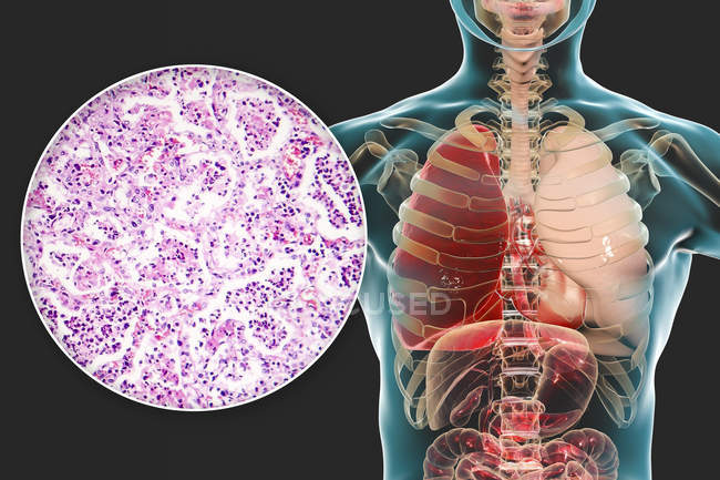 Lungenentzündung im Stadium der roten Hepatisation, digitale Illustration und Lichtmikroskopie. — Stockfoto