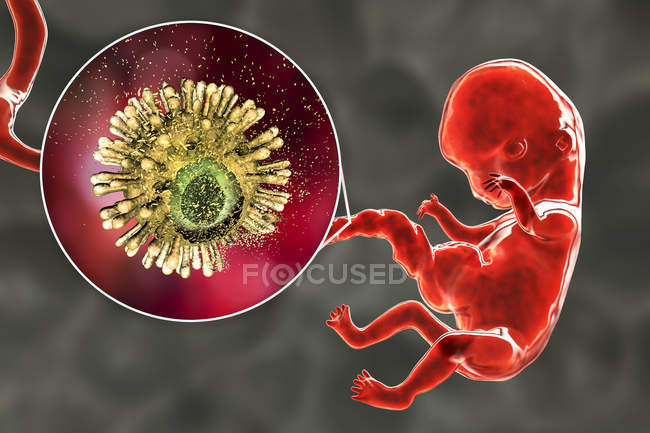 Verhinderung der Übertragung des transplazentären Hiv-Virus von der infizierten Mutter auf den menschlichen Embryo, konzeptionelle Illustration. — Stockfoto