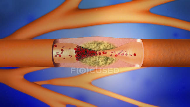 Illustrazione digitale 3d di vasi sanguigni ristretti . — Foto stock