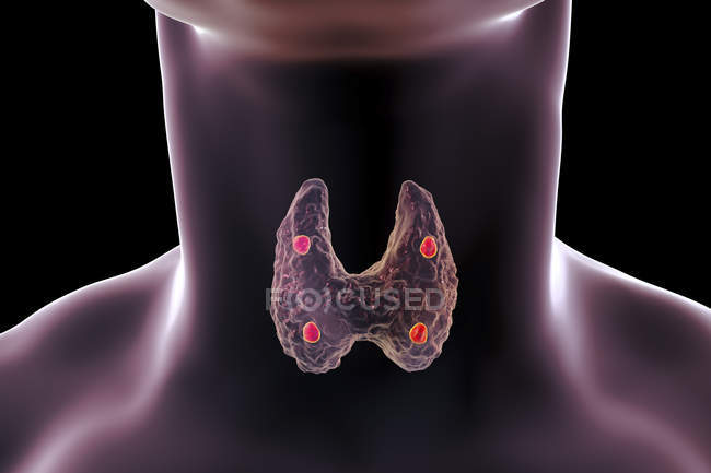 Ilustración digital de glándulas paratiroideas rojas acentuadas situadas detrás de la glándula tiroides en la silueta humana . - foto de stock